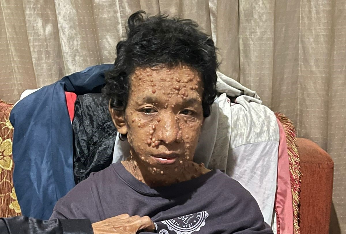 Kondisi Maman Abdurohman (23) warga Jalan Benteng Kidul, Warudoyong, Kota Sukabumi saat mendapat penanganan medis setelah belasan tahun menderita penyakit kulit tanpa identitas kependudukan.
